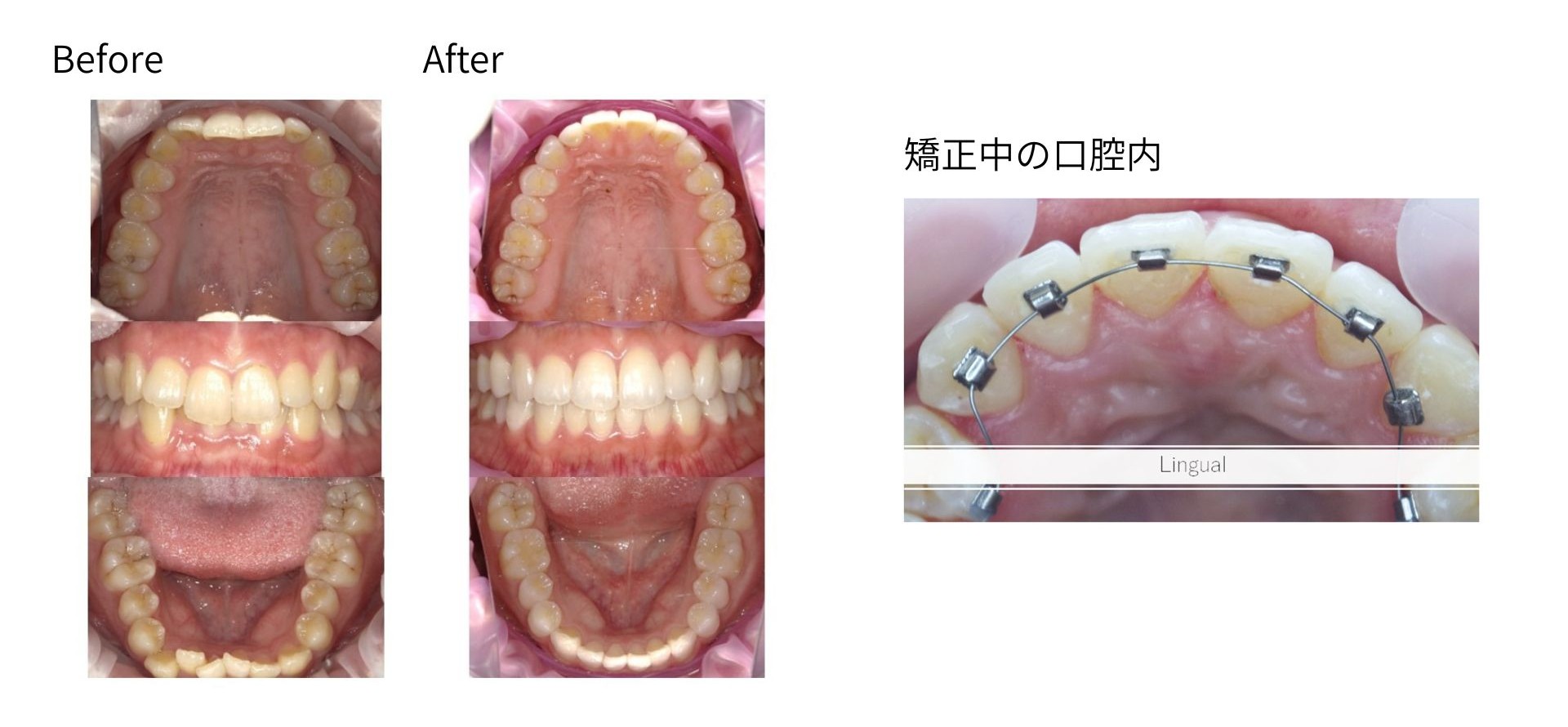 裏側矯正+クリスタルスマイル