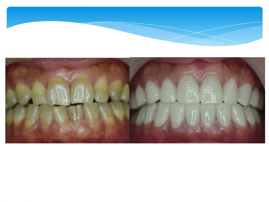 変色歯セラミック審美治療はここまで美しく変われます 恵比寿のインプラント専門歯科医院 ラ エビス クリニ ク デンタル La Ebs Clinique Dental