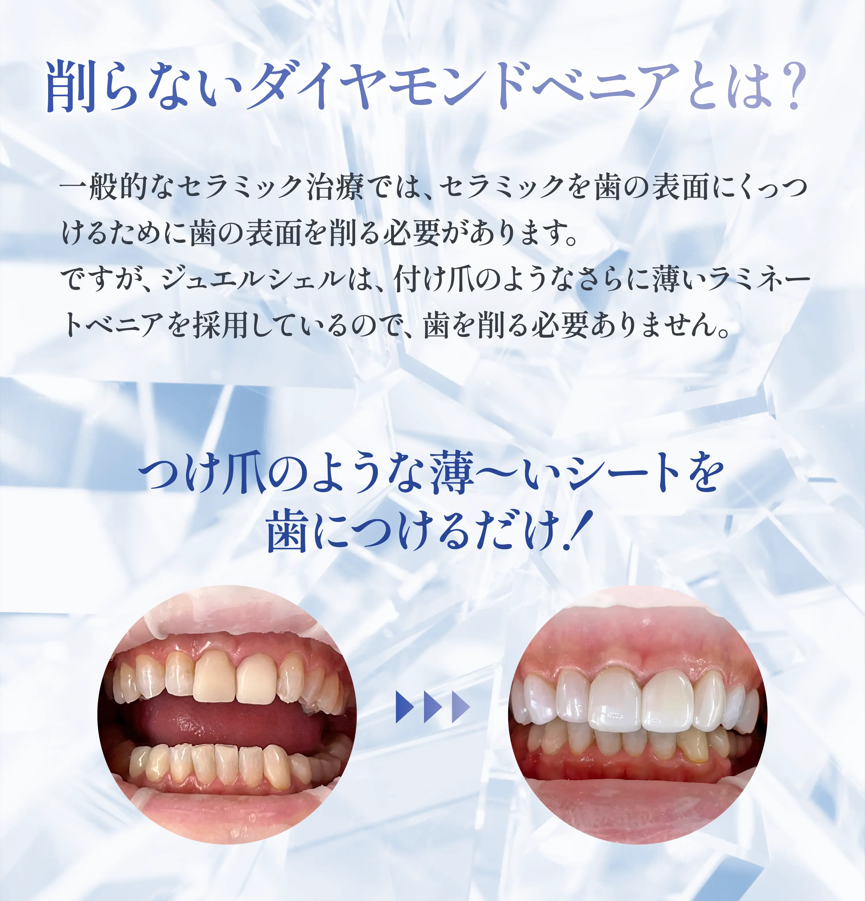 削らないダイヤモンドベニアとは？