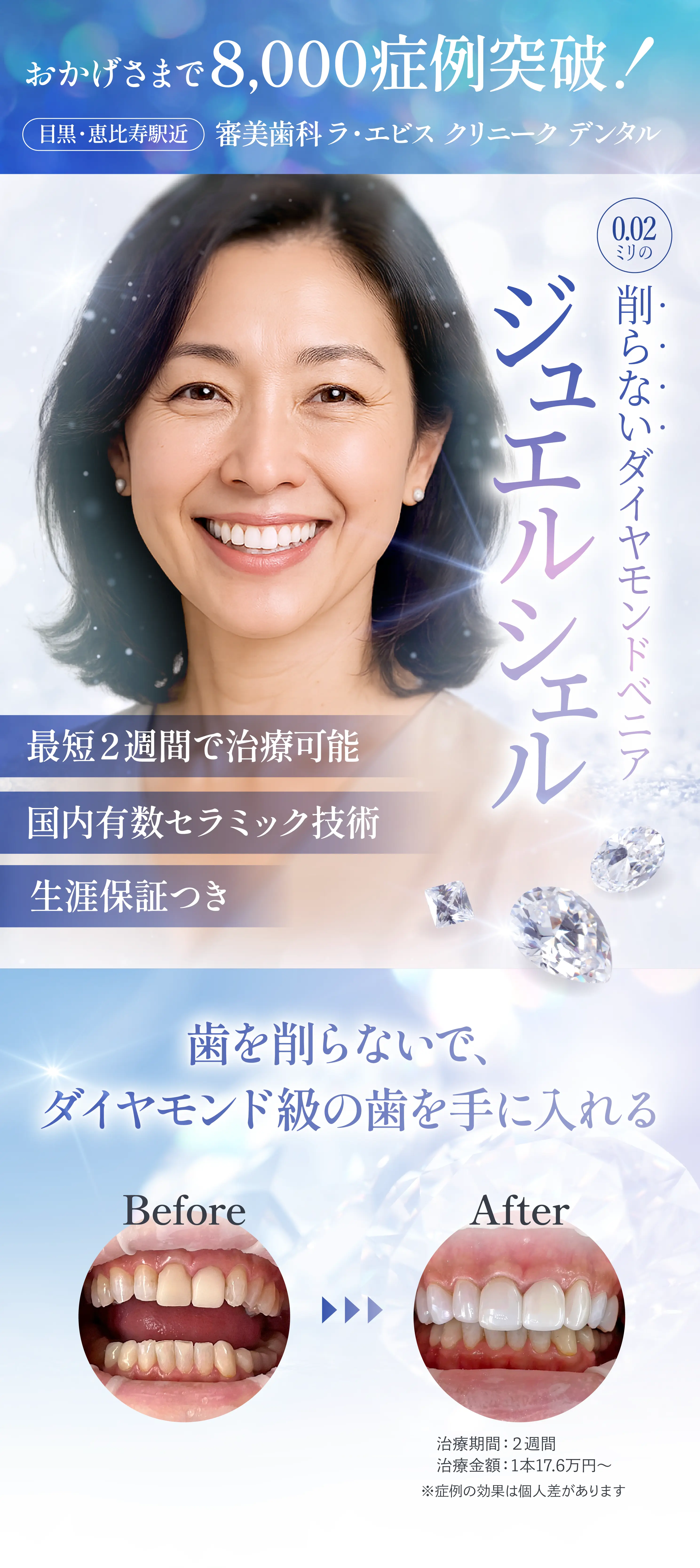 削らないセラミック治療　ジュエルシェル
